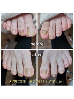爪切り屋 足楽/70代女性の爪ケア