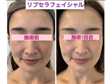 プリュネル(Prunelle)/プラズマシャワー