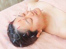 鍼灸治療院ヒカリ(hikari)/【鍼灸】３．施術