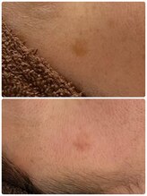 ギャラクシービューティー(galaxy beauty)/光ケア