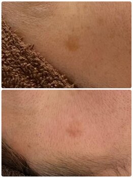 ギャラクシービューティー(galaxy beauty)/光ケア