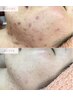 最短で肌の変化を実感!つるすべ透明肌ハーブピーリング(顔)【初回5000円off】