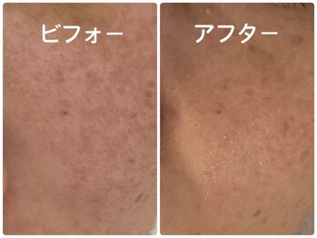 ノーブル シャット Noble Chate/無数のシミが改善されるなんて!