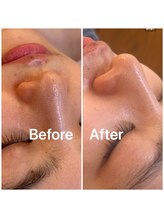 アトリエ ネリネ(Atelier neRine)/毛穴もスッキリ