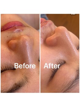 アトリエ ネリネ(Atelier neRine)/毛穴もスッキリ