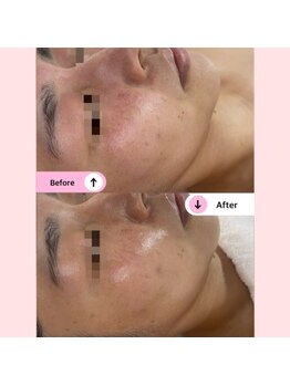 アネラ(ANELA)/赤み