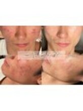 セレア(CELEA)/ニキビケア/大人ニキビ/ニキビ