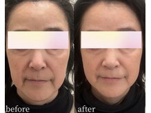 マーリィズエステティック(MARLEY'S AESTHETIC)の雰囲気(サークルショットでフェイスラインのぼやけ、たるみ解決!)