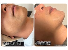 スリーアイ(THREE AI)/◆before→after◆