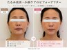 【たるみ改善・ほうれい線】引き締まった印象へ導くWINBACK小顔90分¥10500