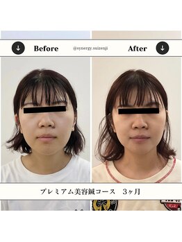 シナジープラス 水前寺店(SYNERGY+)の写真/30代から50代の小顔・たるみ・リフトアップに美容鍼を