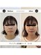 シナジープラス 水前寺店(SYNERGY+)の写真/30代から50代の小顔・たるみ・リフトアップに美容鍼を