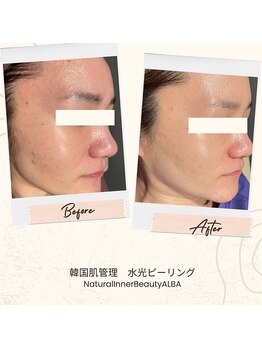 アルバ 広島店(ALBA)/【敏感肌OK】水光ピーリング
