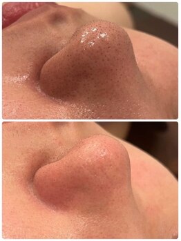 ソラ(Sola)/ハイドラ毛穴洗浄