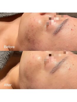 ユカリス(Yu.charis)/水光肌ミコステラ Before→After