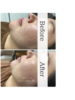 ナーススキン(nurse skin)/ビフォーアフター4