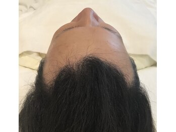 イーズ/リバイタ 熊本店/【CASE4】