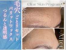 ムーン 高崎店(MOON)/Wax脱毛