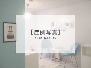 ベル 岡山京橋(Belle)/ハーブピーリング|写真