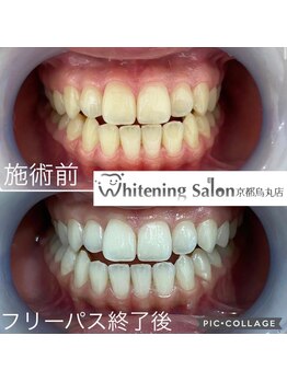 ホワイトニングサロン 京都烏丸店/ホワイトニング施術例