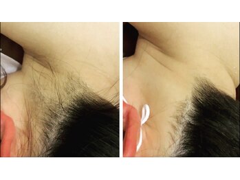 キュール(KuhL)/うなじ脱毛