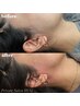 【部分脱毛】お顔の２カ所脱毛/ワックス+光脱毛でツルツル（顔脱毛）