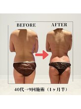フェムビー 千葉駅前店(FEMBE)/痩身）40代の方の変化