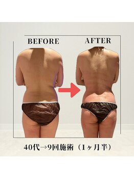 フェムビー 千葉駅前店(FEMBE)/痩身）40代の方の変化