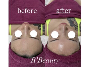 アールビューティー 東新宿店(R’Beauty)/ララピール/ビフォーアフター