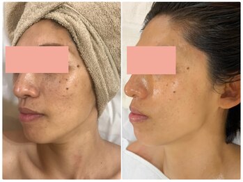 ナトラ 蔵前/40半ばエイジングケア