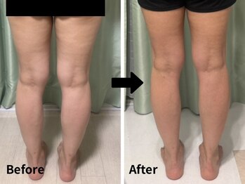 サロンドモモ(SALON de MOMO)/脂肪冷却★脚ビフォーアフター