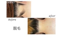 リリー(Lily)/脱毛