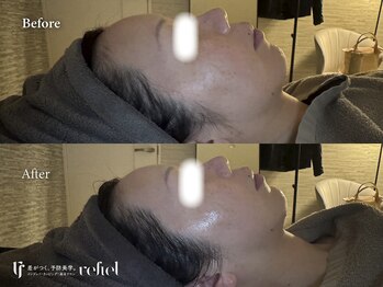 リフィール たまプラーザ店(refiel)/インディバフェイシャル♪