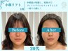限定1名【新人応援】医療提携マシンで初回から変化実感◎小顔にリフトアップ