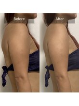 ダリア(Dahlia)/二の腕が気になる方