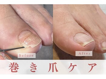 アルヴィス(Arviss)/巻き爪ケア