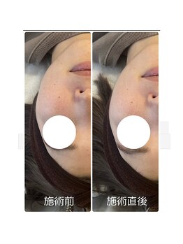 ムー(mu)/光フェイシャル