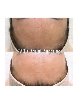 ヒロット タオ(HILOT TAO)/Sugaring 顔脱毛