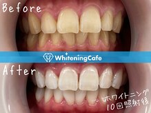 ホワイトニングカフェ 相模大野店(WhiteningCafe)/【ビフォーアフター】10回
