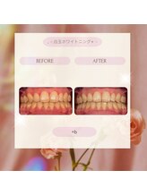 プラスビー 2号店(+b)/ホワイトニングビフォーアフター