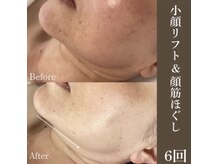 サロンドペシェ(salon de peche)/小顔リフト&顔筋ほぐし6回の変化