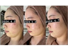 ハリト エステ(HaRi&)/毛穴洗浄/熊本/ハーブピーリング