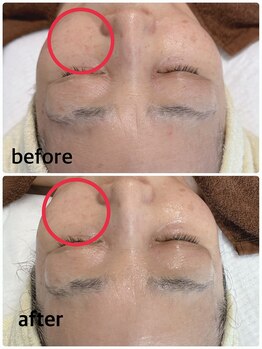 ラルゴ(Largo)/フェイシャルビフォーアフター