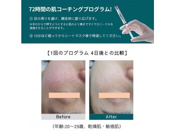 デラッセ サロン ギンザ 藤枝店(Delasser salon GINZA)/メソプロ◎1回施術の効果実感