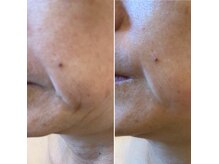 ６０代ほうれい線とあご首たるみ（オーダーメイドフェイシャル）