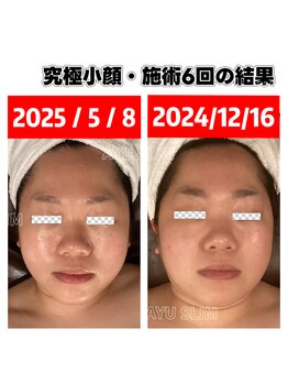 アユスリム(AYU SLIM)/短期集中ケア 究極小顔♪