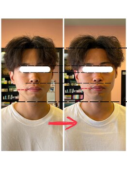 はあと/小顔調整