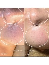 エレン(Elen)/毛穴開きを整える！