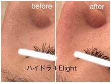 メゾンリュバン 天王寺(Maison Ruban)/毛穴洗浄・美白フォト|毛穴ケア