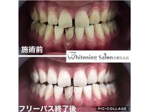 ホワイトニングサロン 京都烏丸店/ホワイトニング施術例